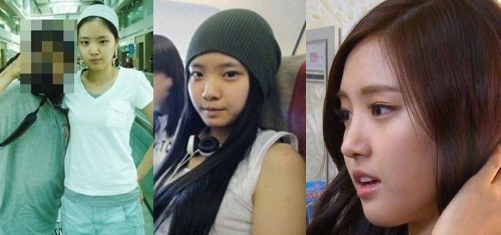 Korean Celebrity Plastic Surgery. 